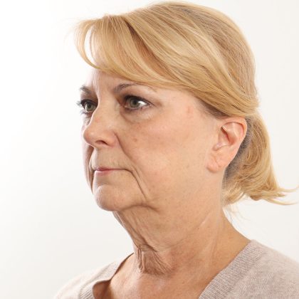 Facelift Before & After Patient #4517