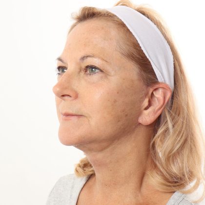 Facelift Before & After Patient #4517