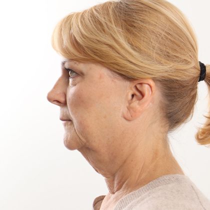 Facelift Before & After Patient #4517