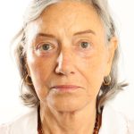 Facelift Before & After Patient #4536