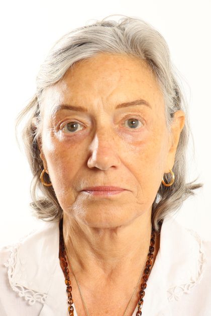 Facelift Before & After Patient #4536