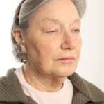 Facelift Before & After Patient #4536