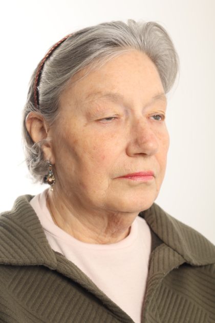 Facelift Before & After Patient #4536