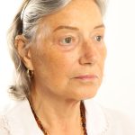 Facelift Before & After Patient #4536