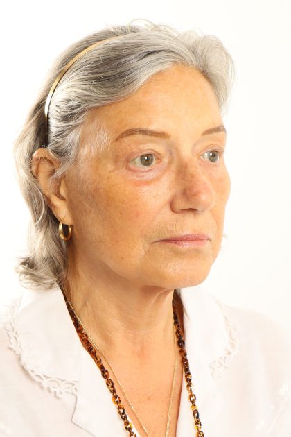 Facelift Before & After Patient #4536