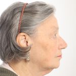 Facelift Before & After Patient #4536