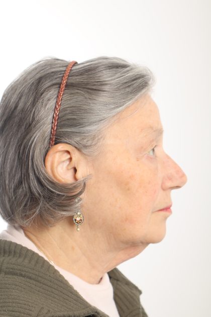 Facelift Before & After Patient #4536