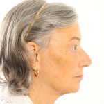 Facelift Before & After Patient #4536