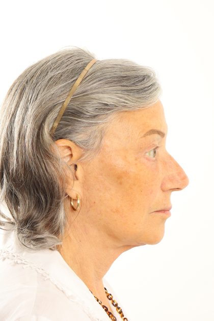 Facelift Before & After Patient #4536
