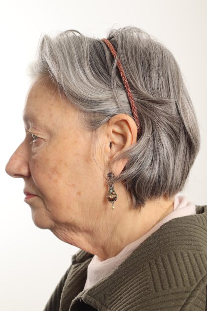 Facelift Before & After Patient #4536