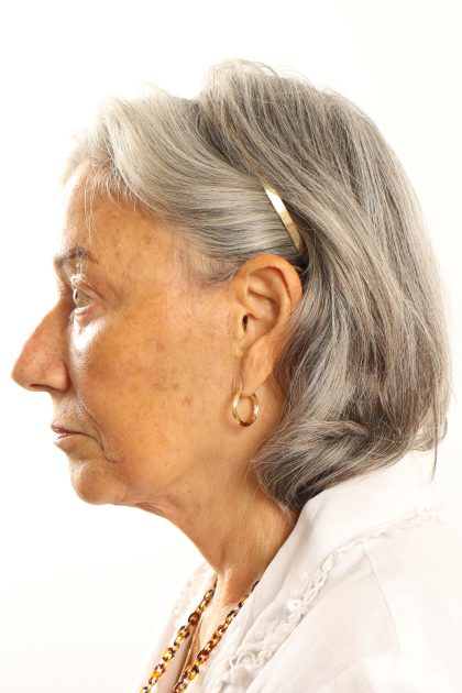 Facelift Before & After Patient #4536