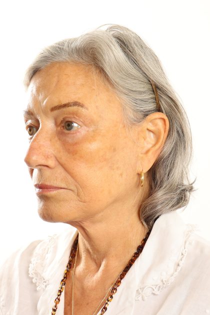 Facelift Before & After Patient #4536