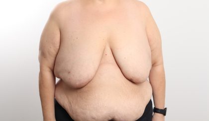 Breast Reduction Before & After Patient #4624