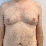 Gynecomastia Before & After Patient #4576