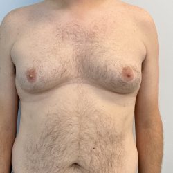 Gynecomastia Before & After Patient #4576