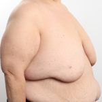 Breast Reduction Before & After Patient #4624
