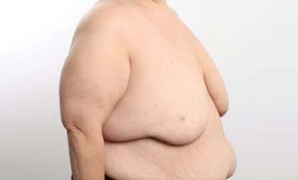 Breast Reduction Before & After Patient #4624