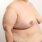 Breast Reduction Before & After Patient #4624