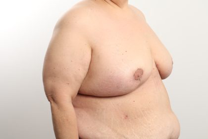 Breast Reduction Before & After Patient #4624