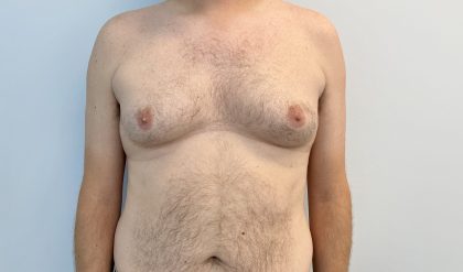Gynecomastia Before & After Patient #4576