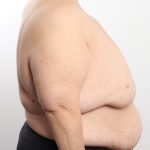 Breast Reduction Before & After Patient #4624