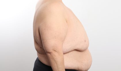 Breast Reduction Before & After Patient #4624