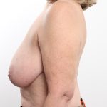 Breast Reduction Before & After Patient #4617