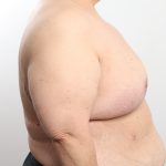 Breast Reduction Before & After Patient #4624