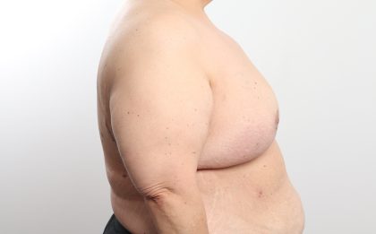Breast Reduction Before & After Patient #4624