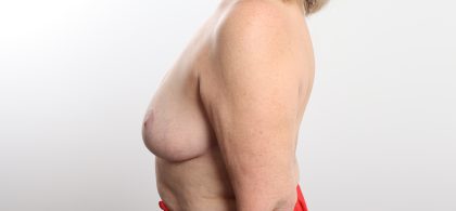 Breast Reduction Before & After Patient #4617