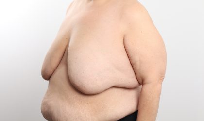 Breast Reduction Before & After Patient #4624