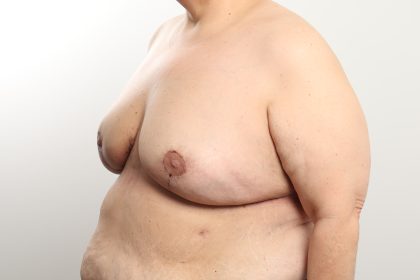 Breast Reduction Before & After Patient #4624