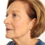 Blepharoplasty Before & After Patient #4665