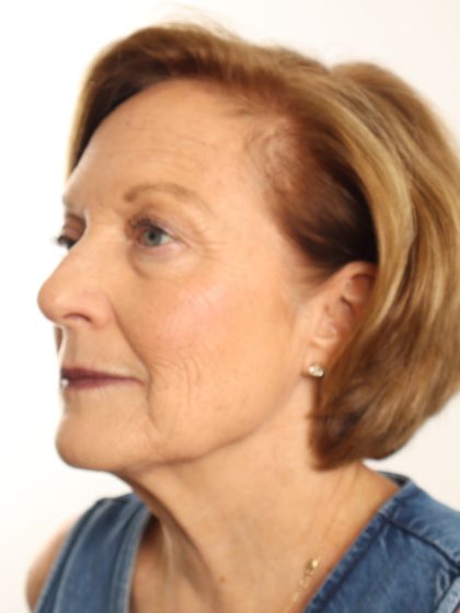 Blepharoplasty Before & After Patient #4665