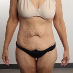 Lower Body Lift Before & After Patient #4633
