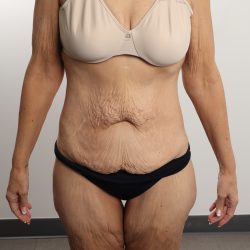 Lower Body Lift Before & After Patient #4633