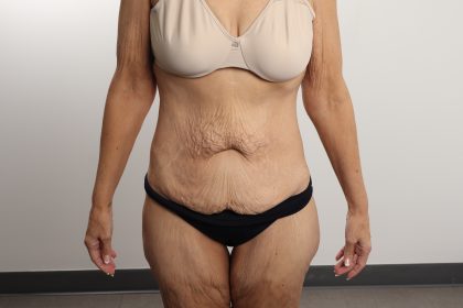 Lower Body Lift Before & After Patient #4633