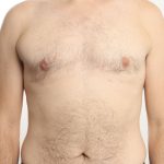 Gynecomastia Before & After Patient #4576