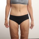 Lower Body Lift Before & After Patient #4633
