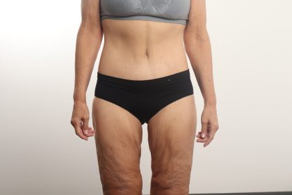 Lower Body Lift Before & After Patient #4633