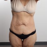 Lower Body Lift Before & After Patient #4633