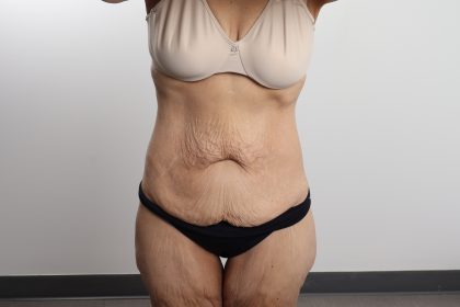 Lower Body Lift Before & After Patient #4633