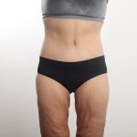 Lower Body Lift Before & After Patient #4633