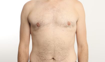 Gynecomastia Before & After Patient #4576