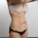 Lower Body Lift Before & After Patient #4633