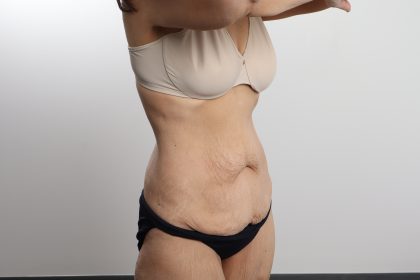 Lower Body Lift Before & After Patient #4633