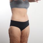 Lower Body Lift Before & After Patient #4633