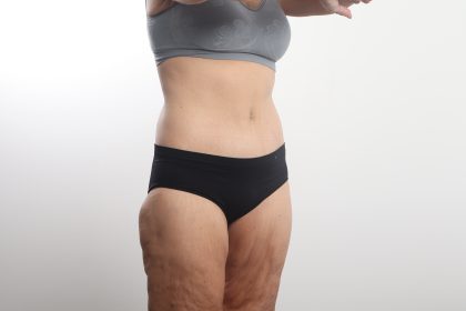 Lower Body Lift Before & After Patient #4633