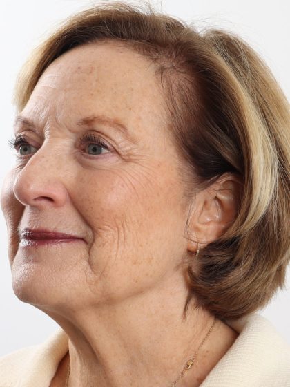 Blepharoplasty Before & After Patient #4665