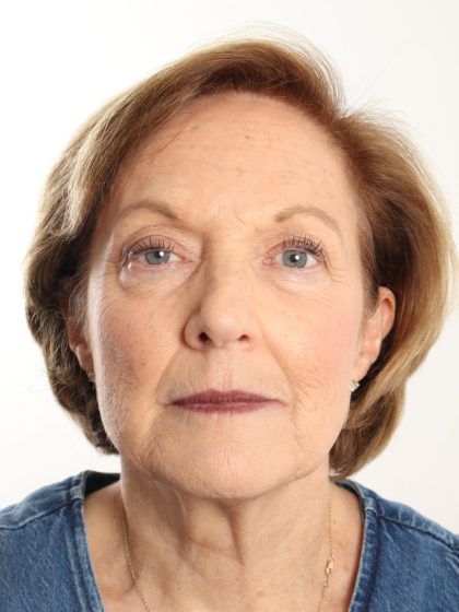 Blepharoplasty Before & After Patient #4665
